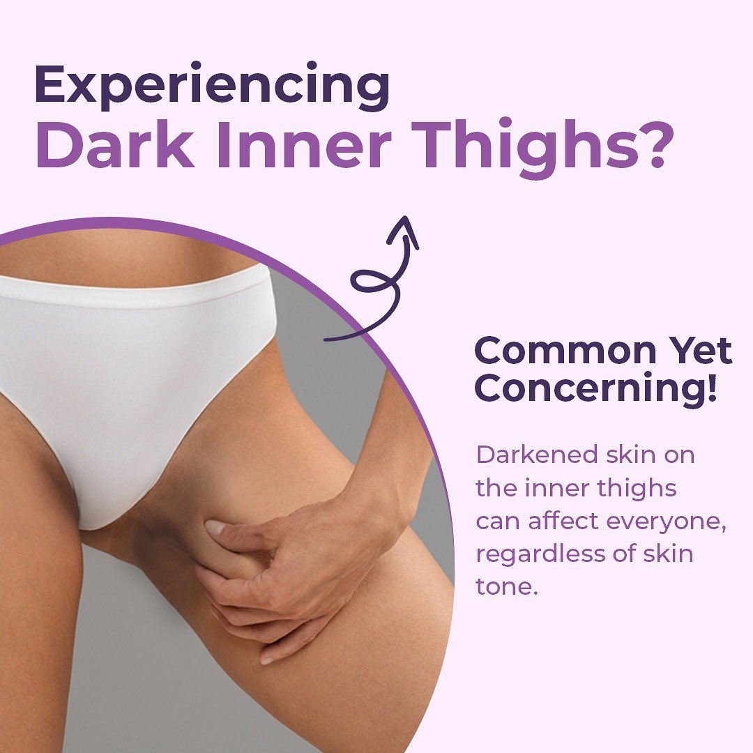 Dark Inner Thighs Cream