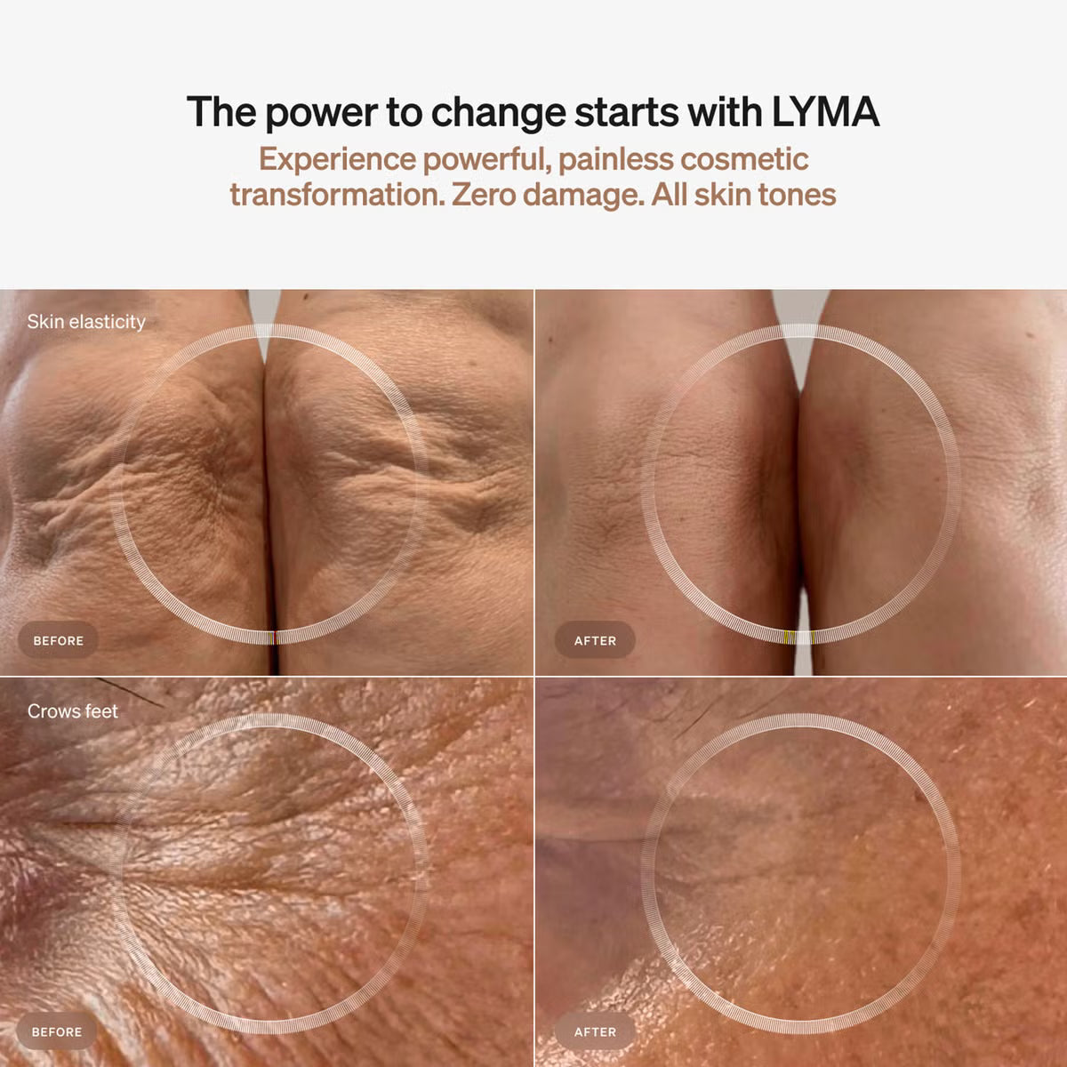 LYMA Laser Starter Kit